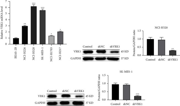 Downregulation of VRK1 Inhibits Progression of Lung Squamous Cell Carcinoma through DNA Damage.