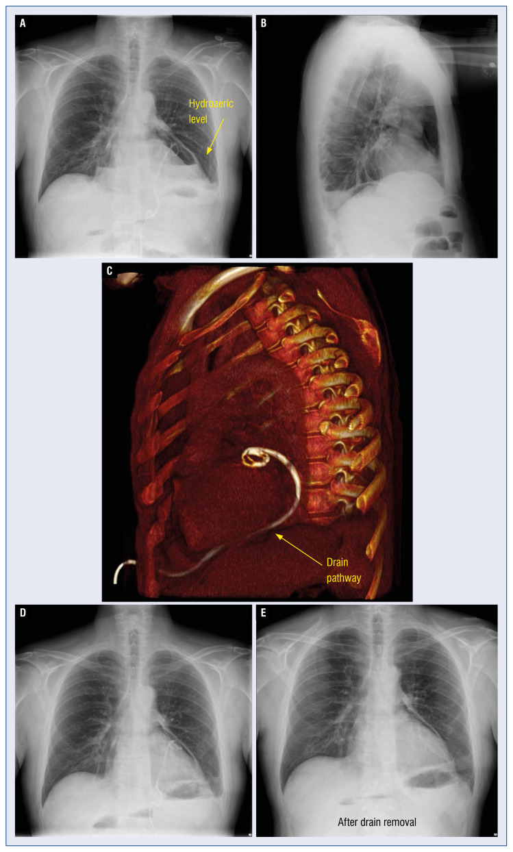 Hydropneumopericardium after pericardiocentesis in a transplant patient.