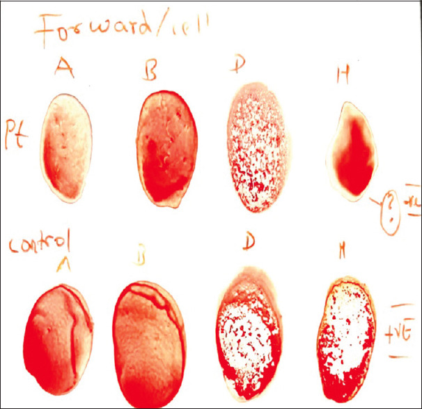 A case report on para-Bombay blood group.