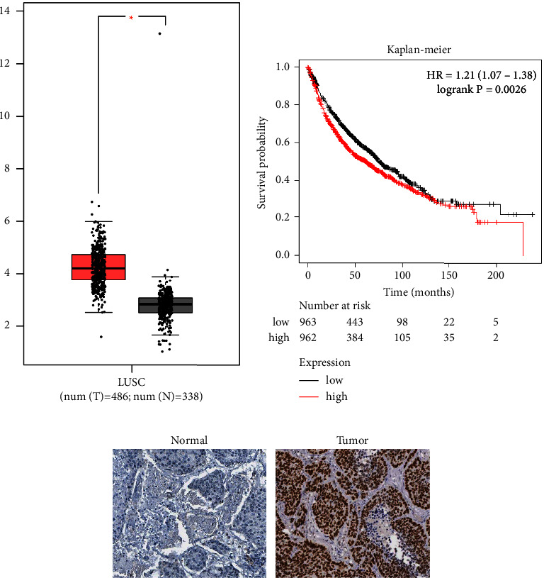 Downregulation of VRK1 Inhibits Progression of Lung Squamous Cell Carcinoma through DNA Damage.