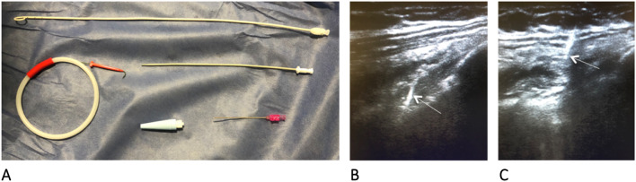 Management of pneumothorax with 8.3-French Pigtail Catheter: description of the ultrasound-guided technique and case series.