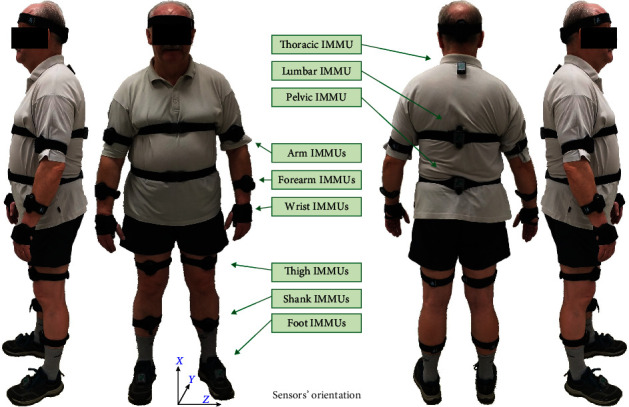 Do Mechatronic Poles Change the Gait Technique of Nordic Walking in Patients with Ischemic Heart Disease?