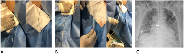 Management of pneumothorax with 8.3-French Pigtail Catheter: description of the ultrasound-guided technique and case series.