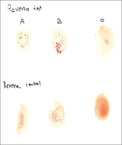 A case report on para-Bombay blood group.