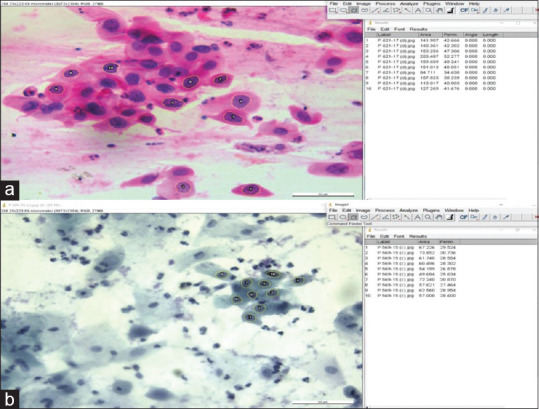 Evaluation of the Cytonucleomorphometric Parameters for Cases Diagnosed as Squamous Cell Abnormality on Conventional Cervico-Vaginal Pap Smears.