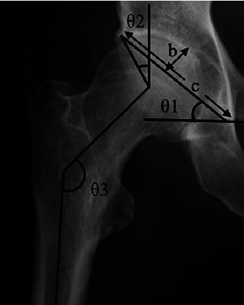 Correlation between Femoral Head Lateralization and Bone Morphology in Primary Hip Osteoarthritis.