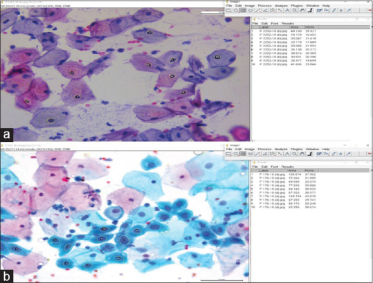 Evaluation of the Cytonucleomorphometric Parameters for Cases Diagnosed as Squamous Cell Abnormality on Conventional Cervico-Vaginal Pap Smears.