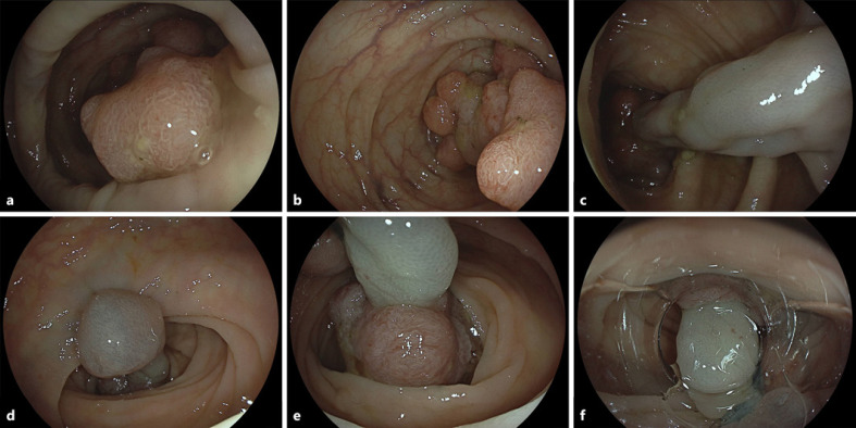 Band Ligation-Assisted Forceps Scissor Transection of a Unique Pedunculated Colorectal Lesion with Stalk Varices.