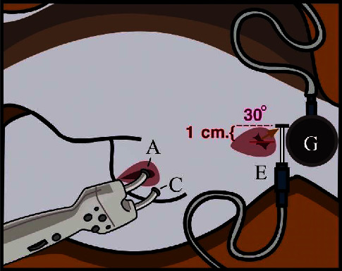 Electromyography of the External Anal Sphincter during Micturition and Electrophysiological Bulbocavernosus Reflex in Healthy Spayed Female Canines.