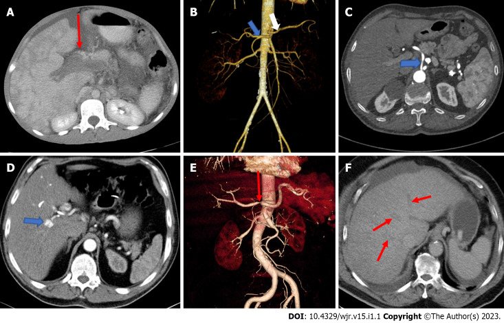 Clinical anatomy of hepatic vessels by computed tomography angiography: A minireview.