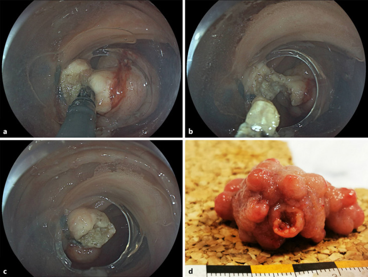 Band Ligation-Assisted Forceps Scissor Transection of a Unique Pedunculated Colorectal Lesion with Stalk Varices.