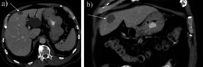 Ciliated Hepatic Foregut Cyst: Definitive Diagnosis Is Critical to the Optimal Treatment Pathway.