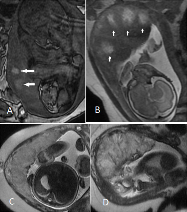 Diagnostic models for the detection of intrauterine growth restriction and placental insufficiency severity based on magnetic resonance imaging of the placenta.