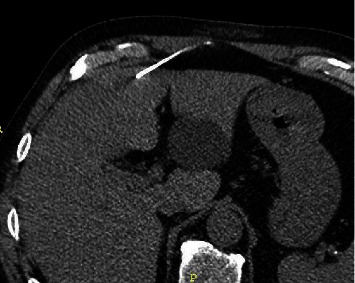 Ciliated Hepatic Foregut Cyst: Definitive Diagnosis Is Critical to the Optimal Treatment Pathway.