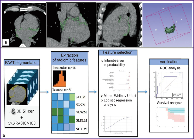 Radiomic Phenotype of Periatrial Adipose Tissue in the Prognosis of Late Postablation Recurrence of Idiopathic Atrial Fibrillation.