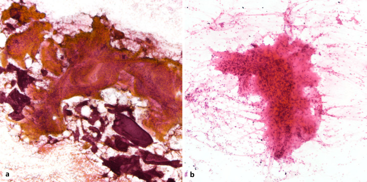 Tubular Adenomas of the Breast Are Cytologically Distinct from Fibroadenomas.