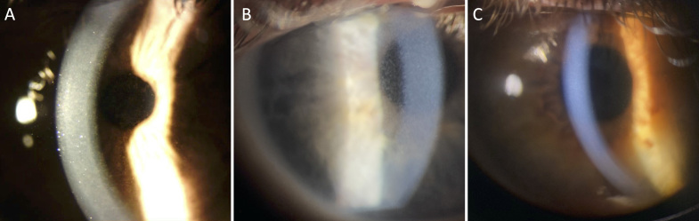 Identification of a novel partial deletion of <i>STS</i> associated with pre-Descemet corneal dystrophy and X-linked ichthyosis.