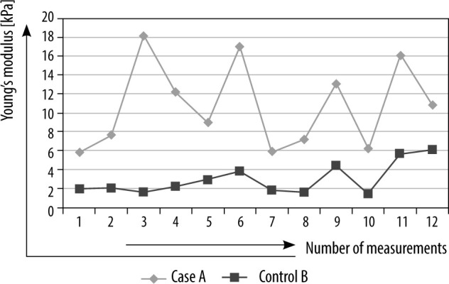 Shear wave elastography: usefulness in chronic kidney disease.