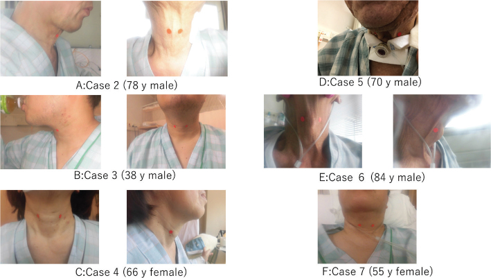 FEASIBILITY STUDY ON SWALLOWING TELEREHABILITATION IN PATIENTS WITH CORONAVIRUS DISEASE 2019.