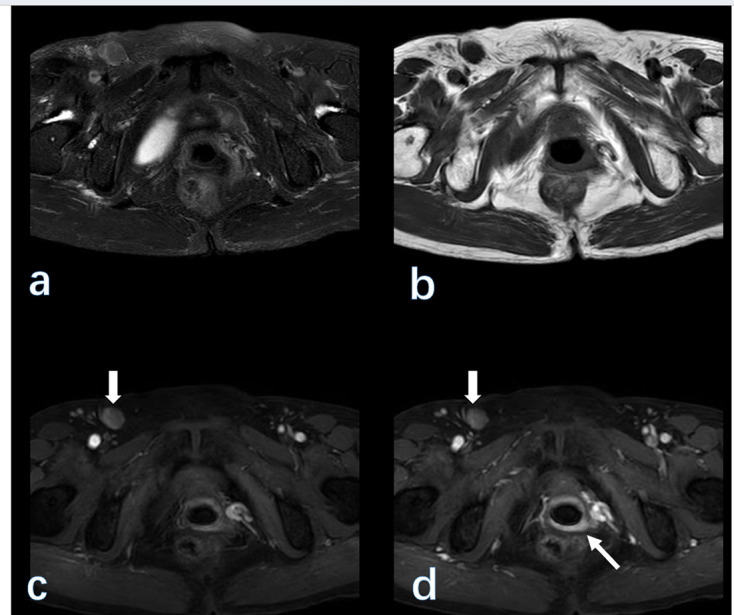 Common and uncommon lesions of the vulva and vagina on magnetic resonance imaging: correlations with pathological findings.