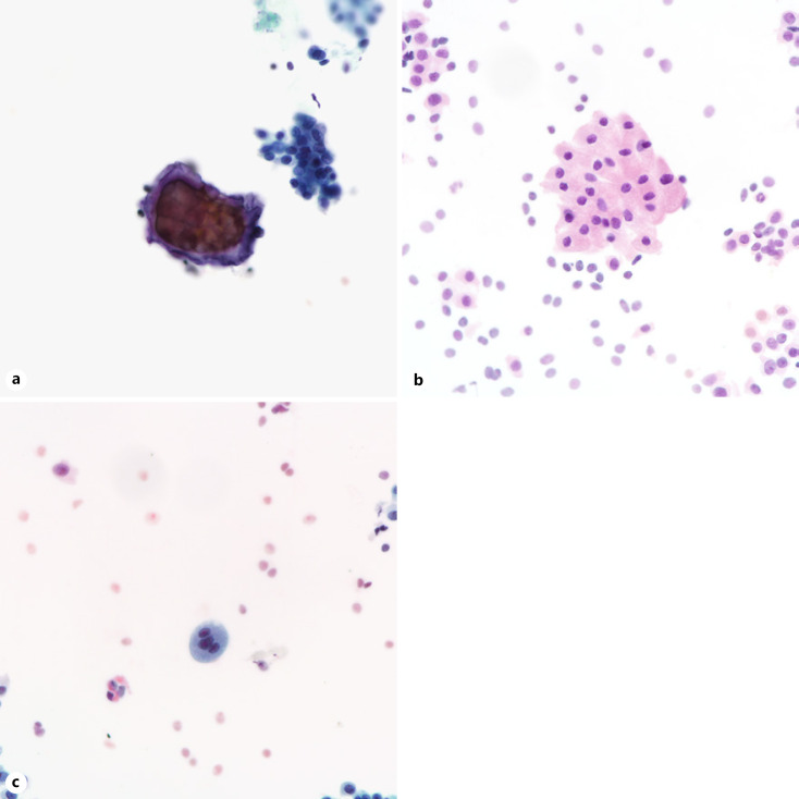 Tubular Adenomas of the Breast Are Cytologically Distinct from Fibroadenomas.