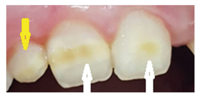 Assessment of oral manifestations in pediatric patients with celiac disease in relation to marsh types.