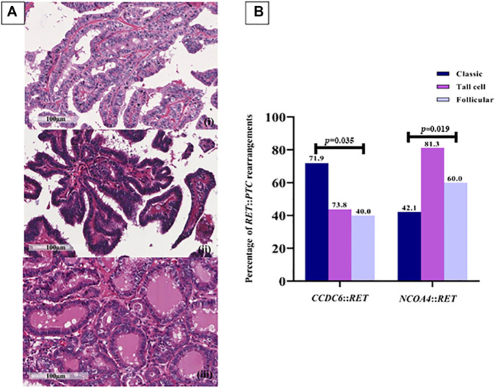 <i>RET</i> rearrangements are relevant to histopathologic subtypes and clinicopathological features in Thai papillary thyroid carcinoma patients.