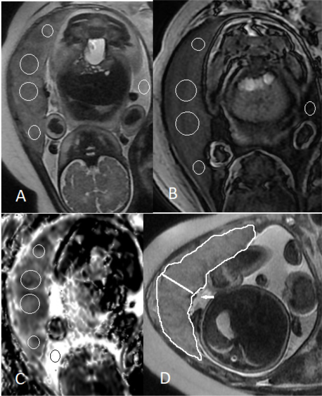 Diagnostic models for the detection of intrauterine growth restriction and placental insufficiency severity based on magnetic resonance imaging of the placenta.