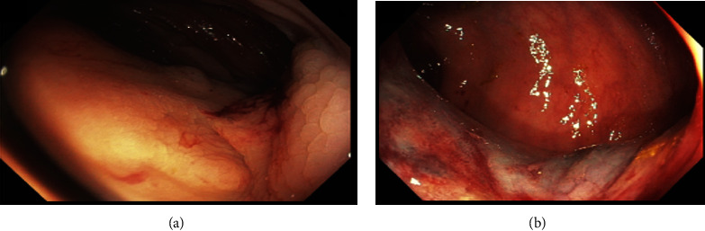 Ectopic Cecal Varices as a Cause of Lower Gastrointestinal Bleeding.