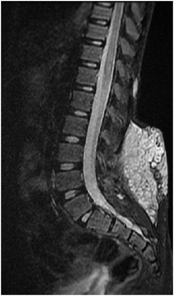 Strangled by His Nerves-Cervical Plexiform Neurofibroma With Infantile Spinal Neurofibromatosis: Case Report in a 14 Years Old Child.