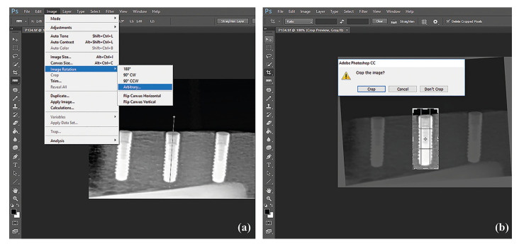 Evaluation of the different exposure parameters for the accurate diagnosis of peri-implantitis severity in digital panoramic radiography.