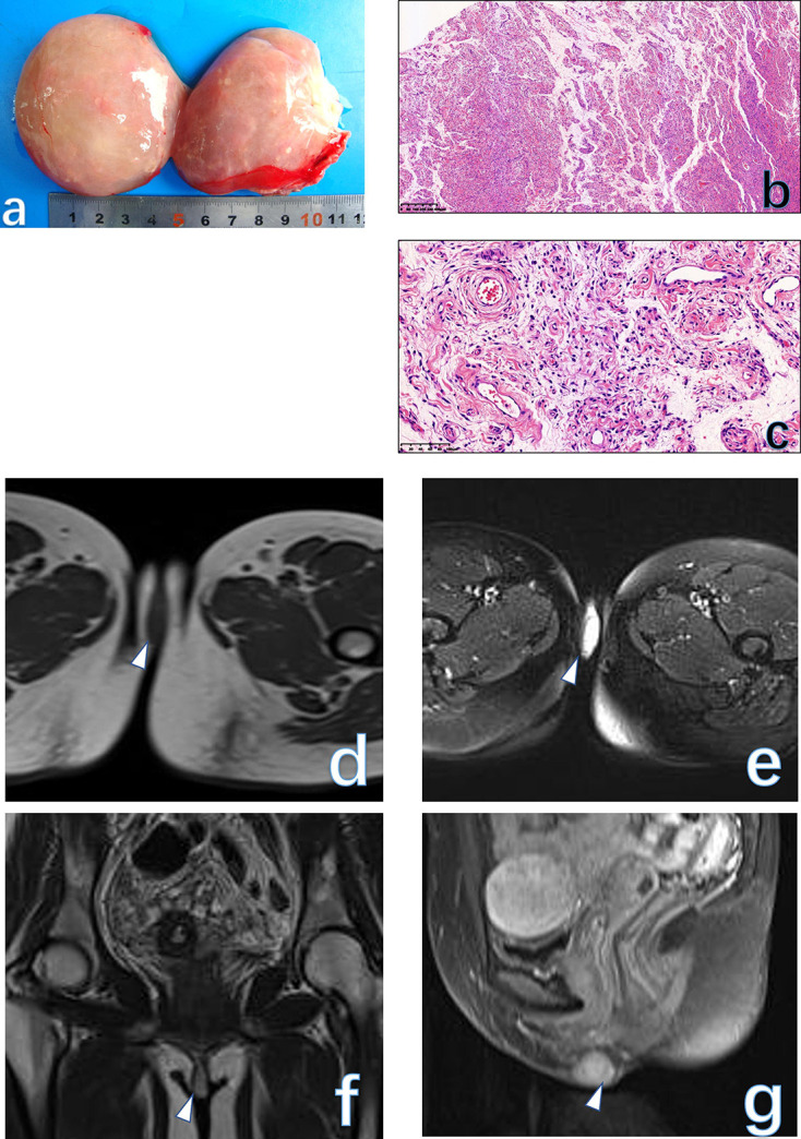 Common and uncommon lesions of the vulva and vagina on magnetic resonance imaging: correlations with pathological findings.