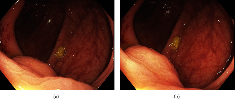 Ectopic Cecal Varices as a Cause of Lower Gastrointestinal Bleeding.