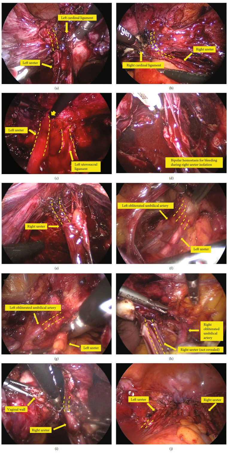 Ureter Injury in Total Laparoscopic Hysterectomy.