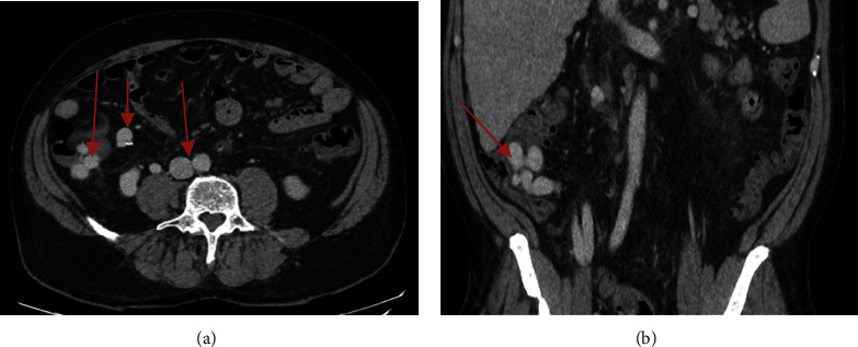 Ectopic Cecal Varices as a Cause of Lower Gastrointestinal Bleeding.