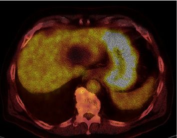 Ciliated Hepatic Foregut Cyst: Definitive Diagnosis Is Critical to the Optimal Treatment Pathway.