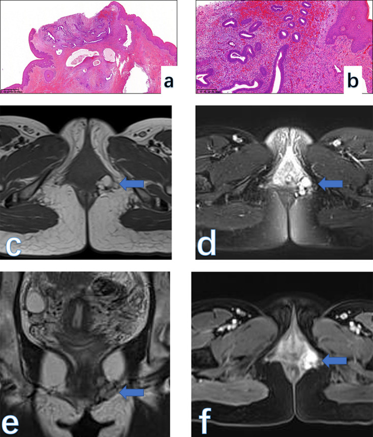 Common and uncommon lesions of the vulva and vagina on magnetic resonance imaging: correlations with pathological findings.