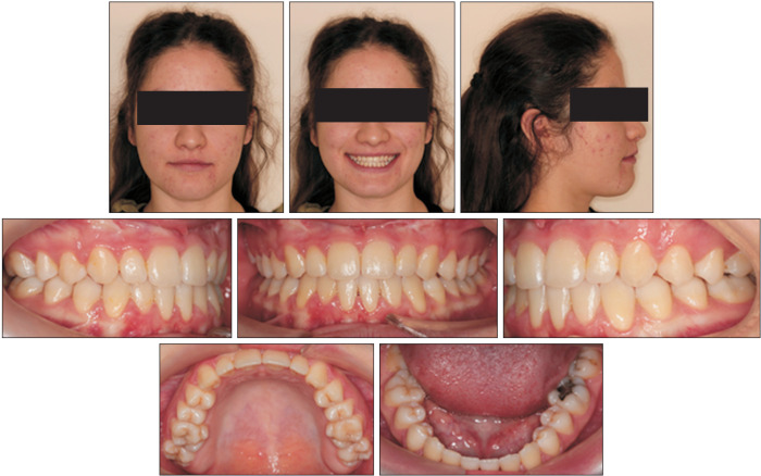 Correction of late adolescent skeletal Class III using the Alt-RAMEC protocol and skeletal anchorage.