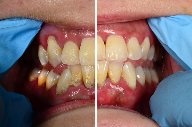 Adalimumab for the Treatment of Periodontitis in a 35-Year-Old Woman with Hidradenitis Suppurativa.