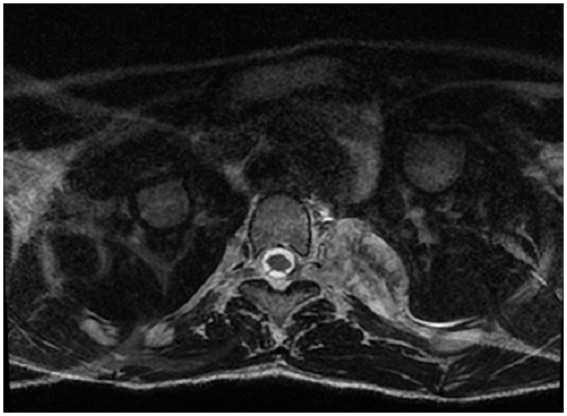 Strangled by His Nerves-Cervical Plexiform Neurofibroma With Infantile Spinal Neurofibromatosis: Case Report in a 14 Years Old Child.