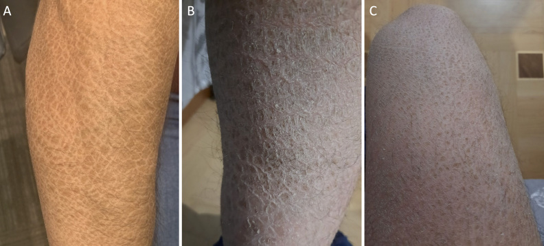 Identification of a novel partial deletion of <i>STS</i> associated with pre-Descemet corneal dystrophy and X-linked ichthyosis.