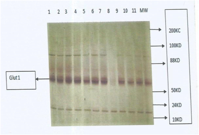 L-Arginine supplementation enhanced expression of glucose transporter (GLUT 1) in sickle cell anaemia subjects in the steady state