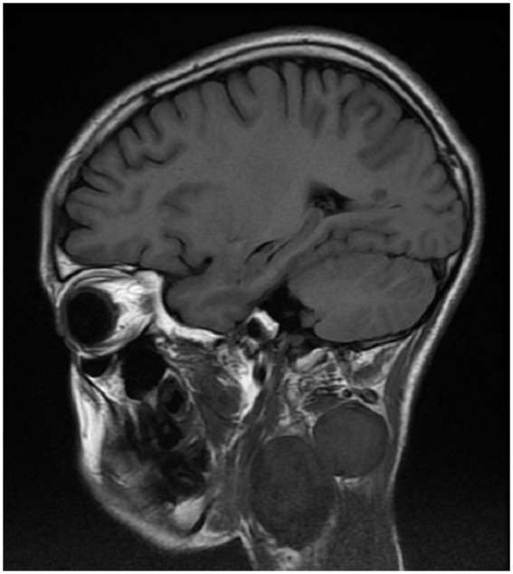 Strangled by His Nerves-Cervical Plexiform Neurofibroma With Infantile Spinal Neurofibromatosis: Case Report in a 14 Years Old Child.