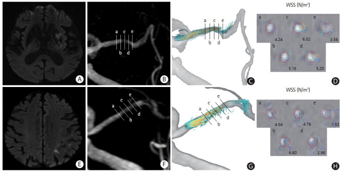 Wall Shear Stress Associated with Stroke Occurrence and Mechanisms in Middle Cerebral Artery Atherosclerosis.