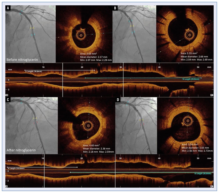 Vasomotor function and optical coherence tomography follow-up 4 years after Fantom bioresorbable scaffold implantation: A case report.
