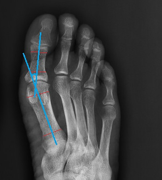 Correlation analysis between foot deformity and diabetic foot with radiographic measurement.