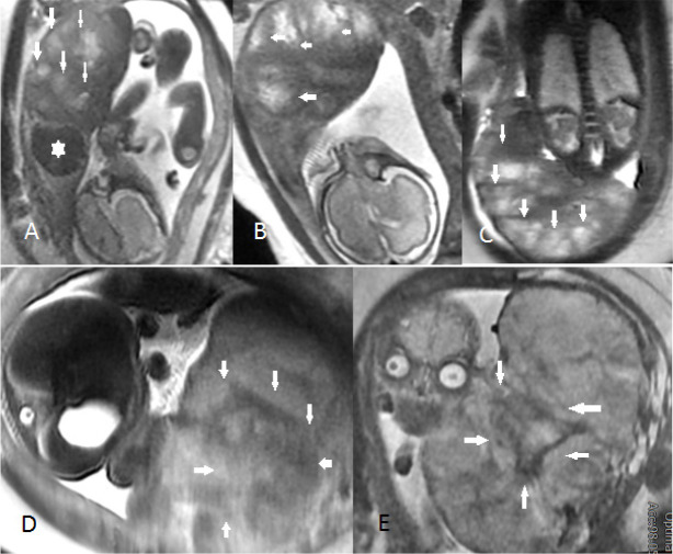 Diagnostic models for the detection of intrauterine growth restriction and placental insufficiency severity based on magnetic resonance imaging of the placenta.