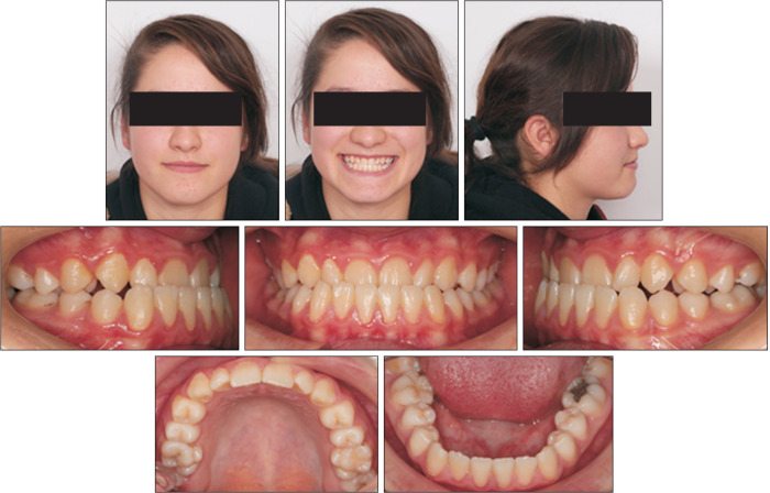 Correction of late adolescent skeletal Class III using the Alt-RAMEC protocol and skeletal anchorage.