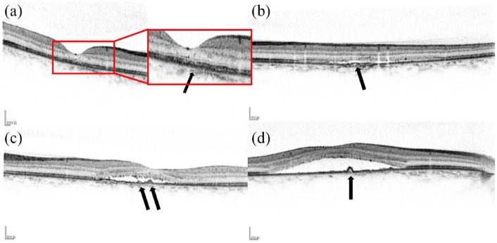 Optical coherence tomography biomarkers as predictors of transition to chronic central serous chorioretinopathy after retinal laser photocoagulation.