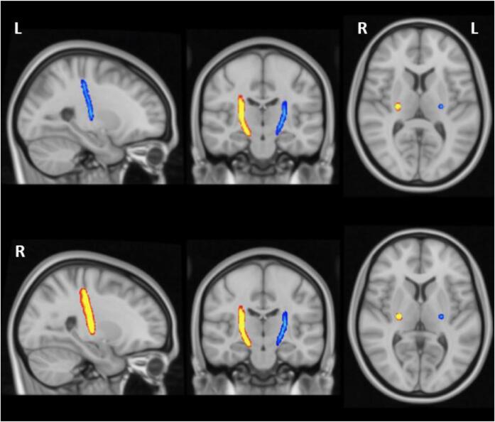 Aberrant corticospinal tract characteristics in prodromal PD: A diffusion tensor imaging study